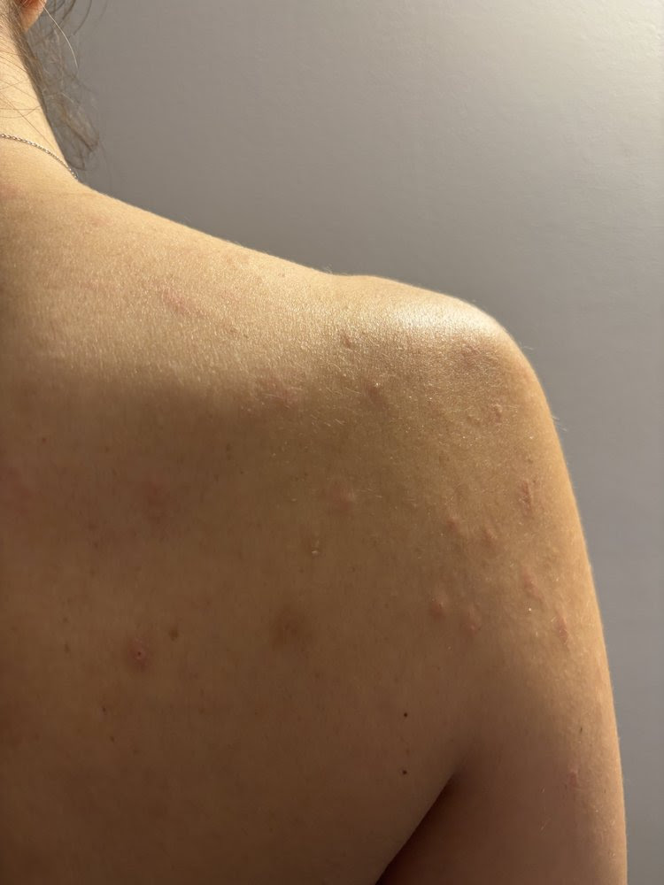 Fotografia personale della pelle della schiena e della spalla con acne