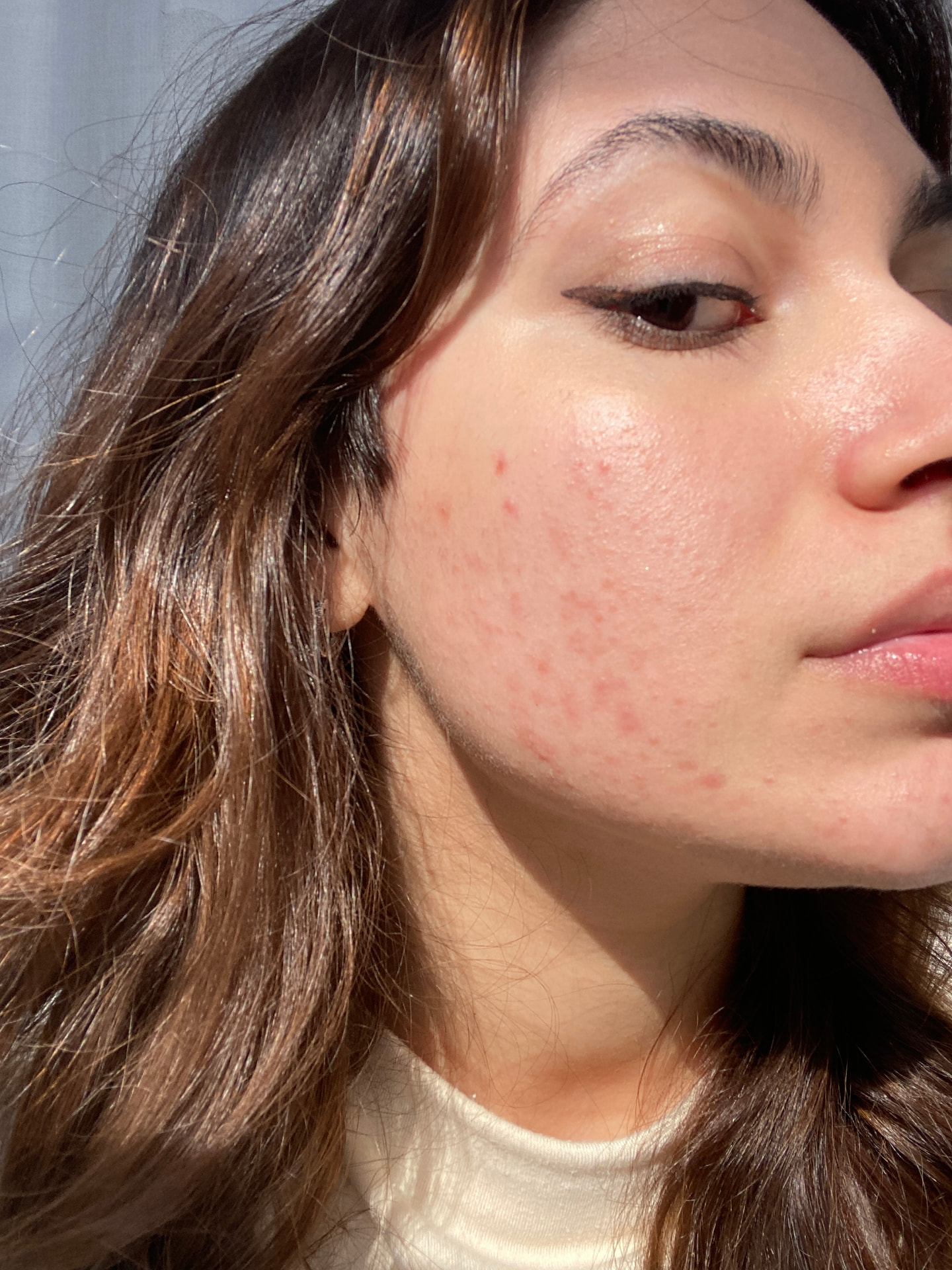 Fotografia personale di un volto con acne, alla luce naturale