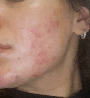 Dettaglio di una guancia con acne